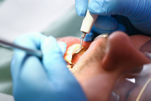 Best Emergency Tooth Extraction in Germantown, MD